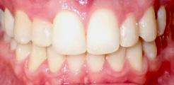 after photo